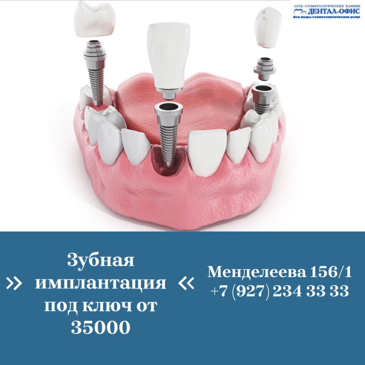 Зубная имплонтация под ключ